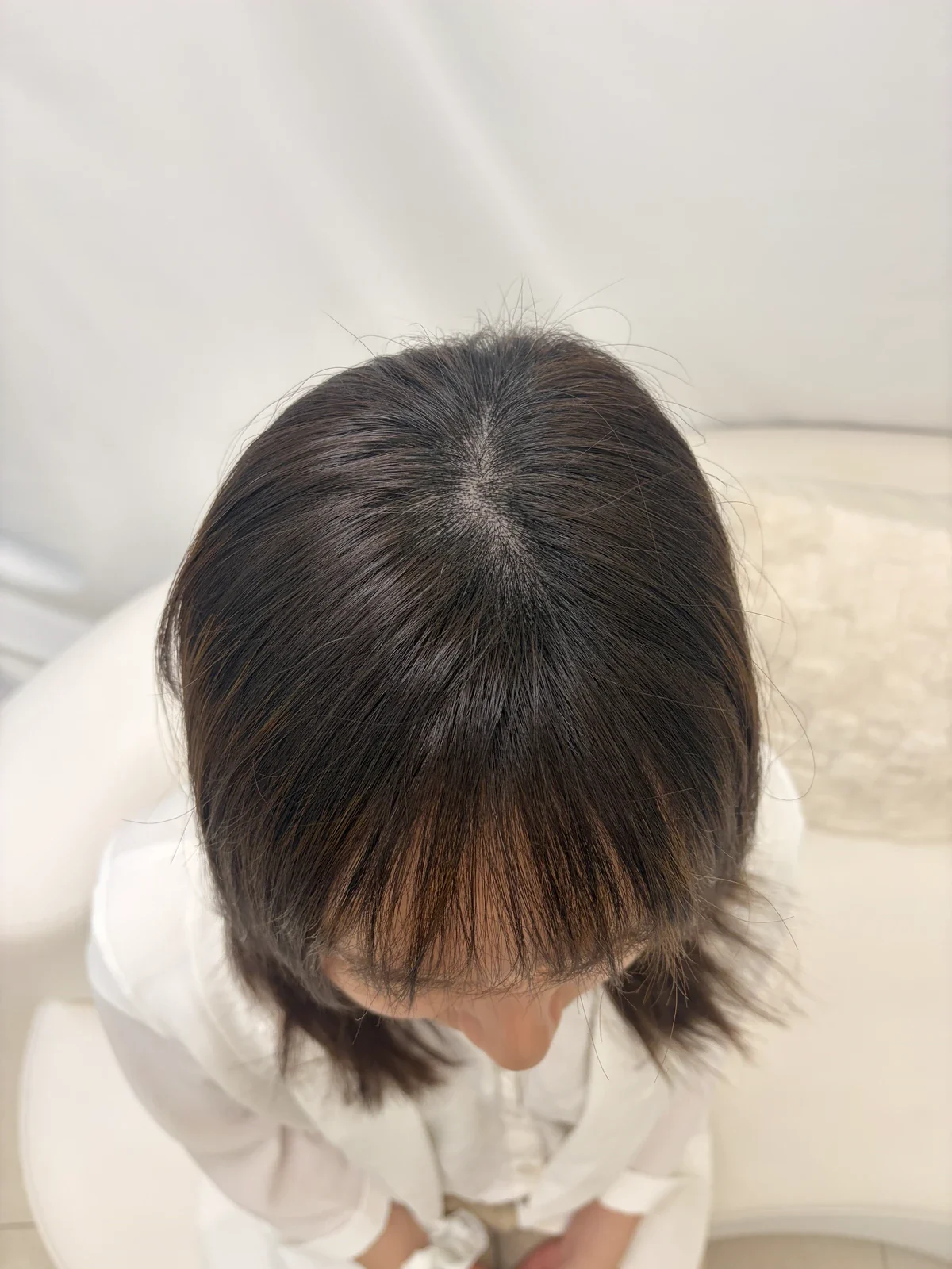 個案 01：療程前，頭頂髮旋及分界位置