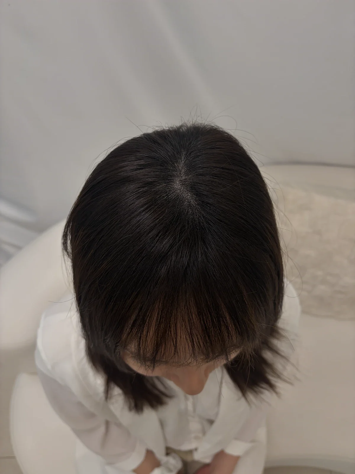 個案 01：療程後，頭頂髮旋及分界位置
